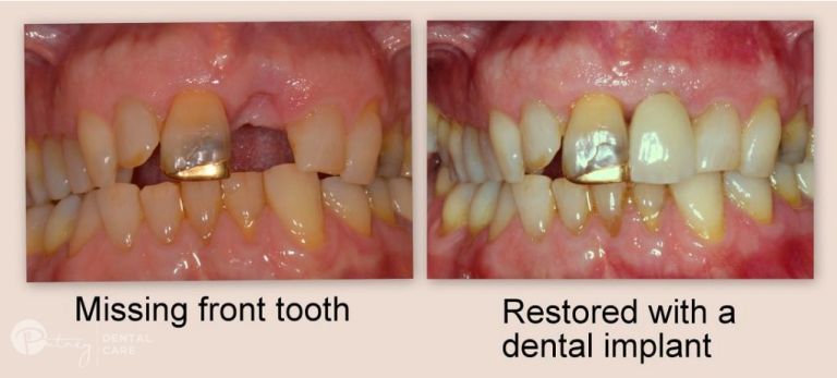 Dental Implants 1 768x347
